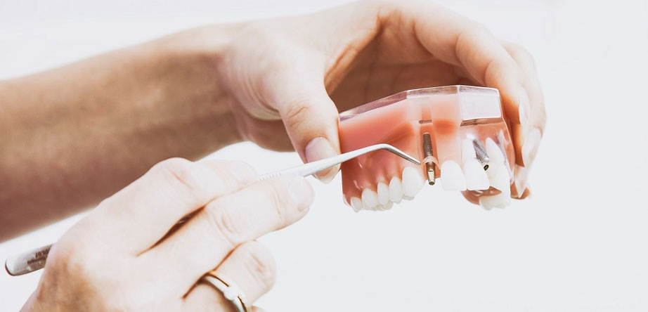 Dental Implant Failure dentist tijuana