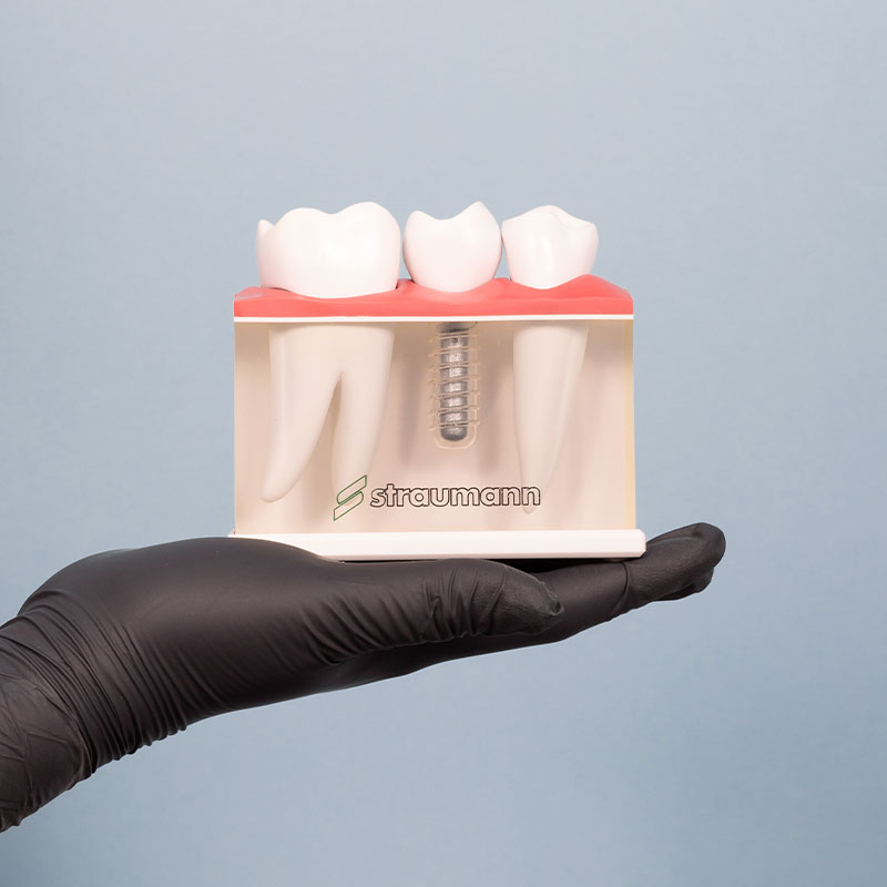 Dental implants cost in tijuana