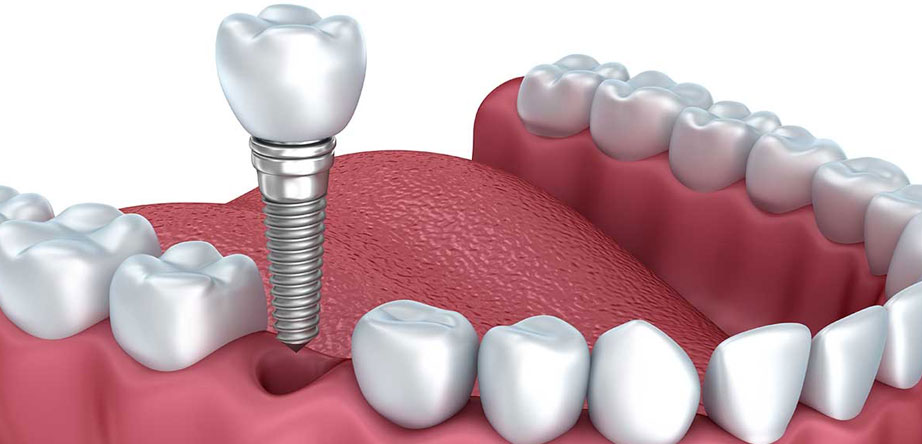 Do you plan to get Dental Implant Surgery