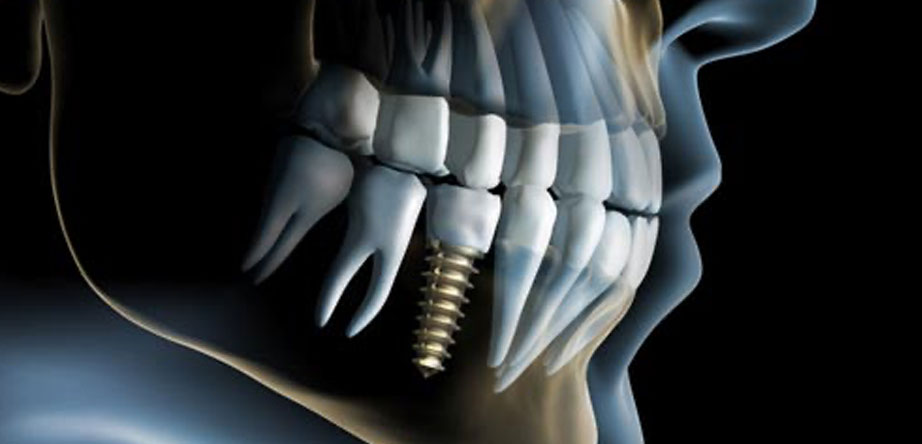 Do you plan to get Dental Implant Surgery