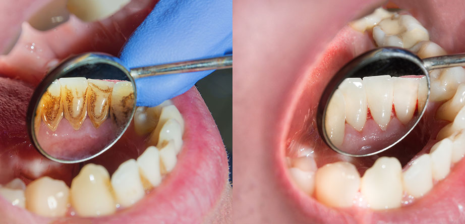 periodontics treatment in tijuana dentist