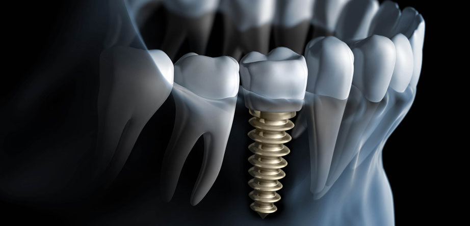 dental implant cost tijuana dentist