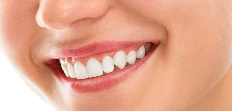 teeth whitening at home Tijuana dentist