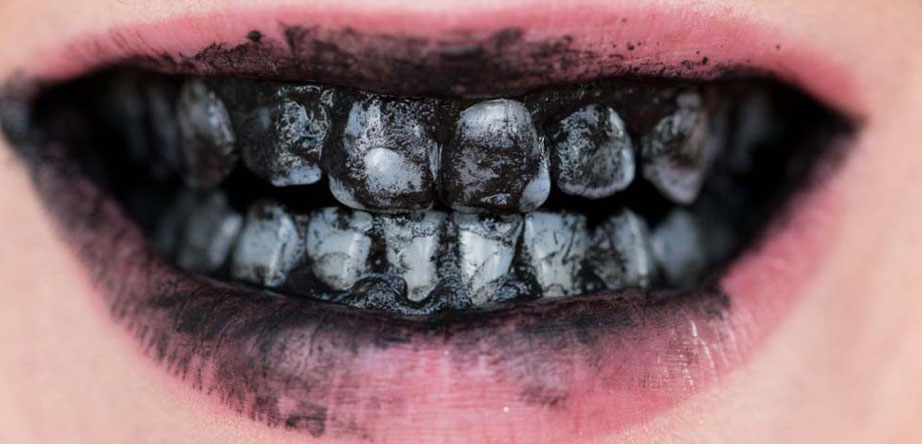 charcoal teeth whitening dentist tijuana