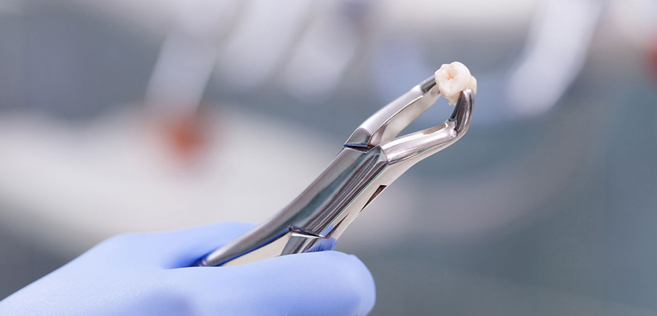 Tooth extractions in tijuana dentist