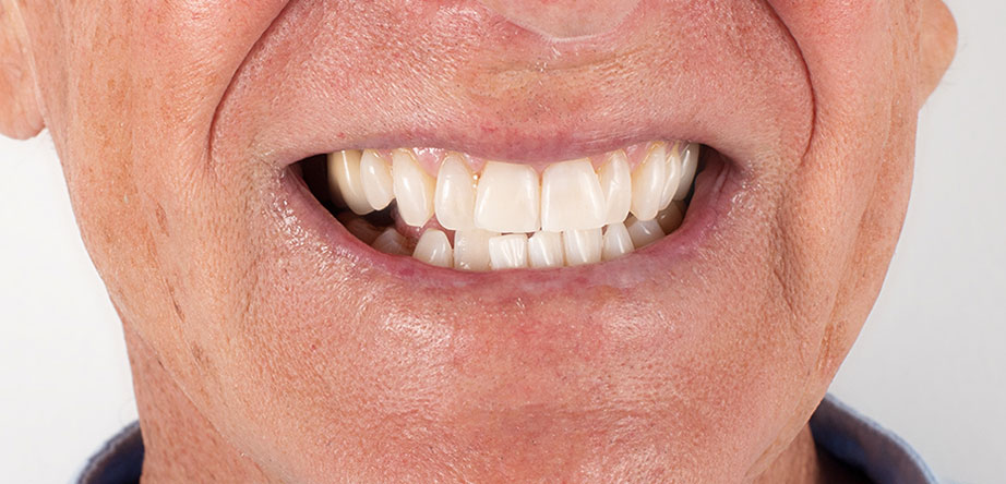 Zoom teeth whitening Tijuana