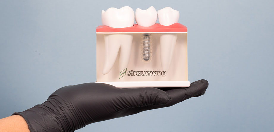 Top questions people are asking about dental implants