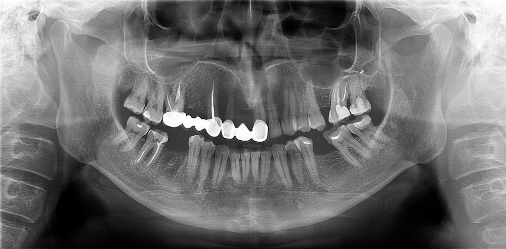 Bone loss in teeth what to do