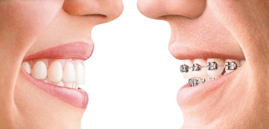 How Much do Braces Cost? 2023 Guide