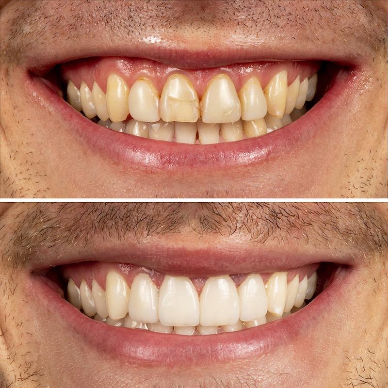 Smile Design with Veneers: Customizing Your Perfect Smile at I love my dentist®.