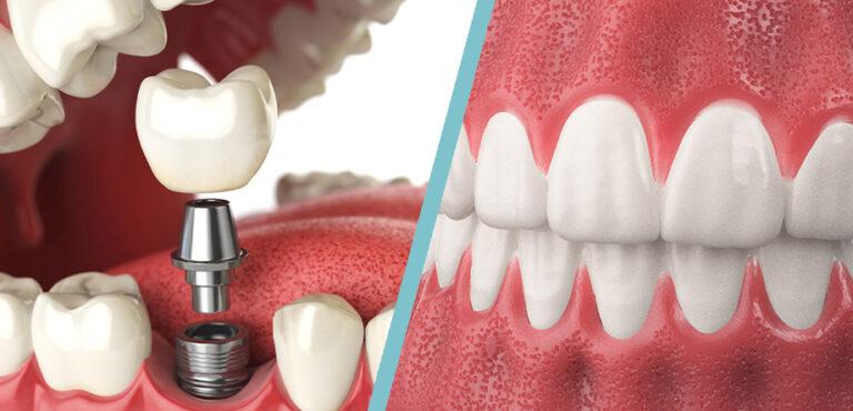 Dental Implants Vs Dentures Choosing The Right Tooth Replacement Option 
