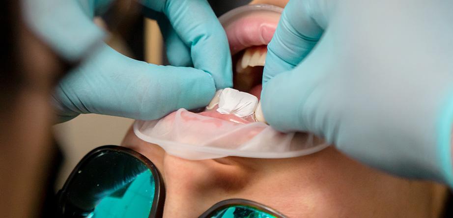Exploring Veneers: A Glimpse into Smile Transformation, I love my dentist Tijuana