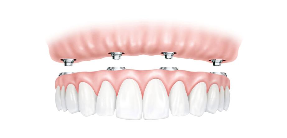 All-on-4® Dental Implants: A Smile Solution for All Ages