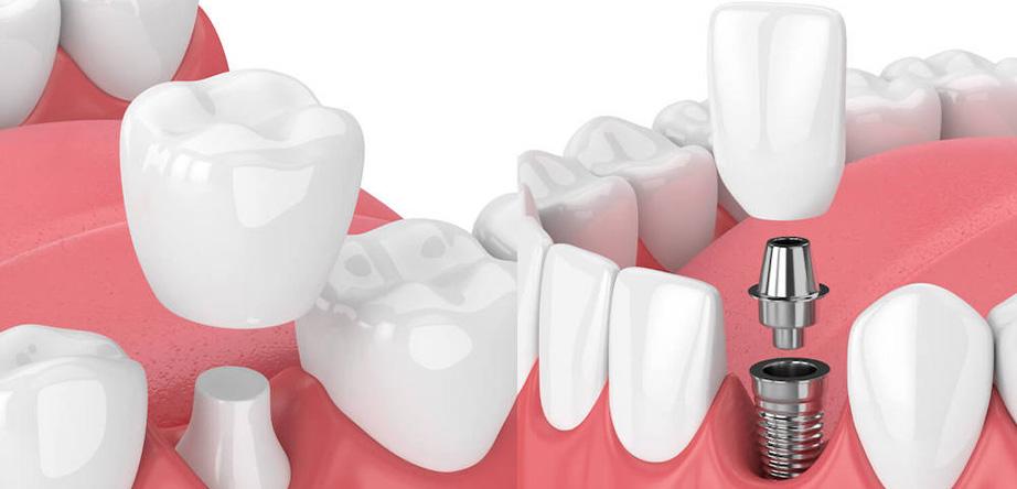 Tooth Loss Solutions: A Comprehensive Guide to Your Options at I love my dentist