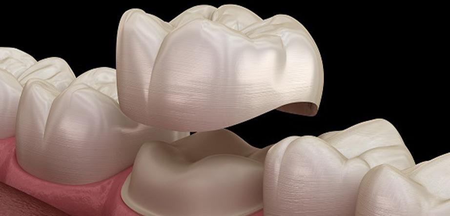 From Chipped to Chic: How Dental Crowns Transform Damaged Teeth