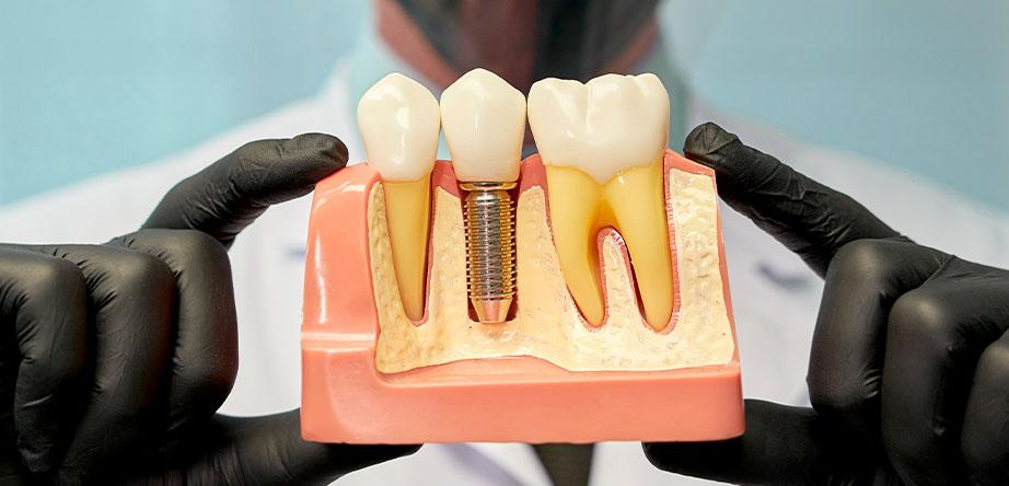 All You Need to Know About Dental Implants Tijuana