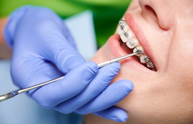 Braces or Invisalign? Choosing the Right Certified Orthodontic Solution in Tijuana