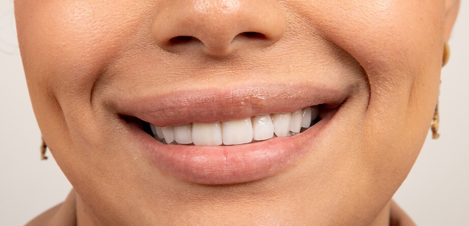 Achieving a Hollywood Smile in Tijuana: Are Veneers Right for You?