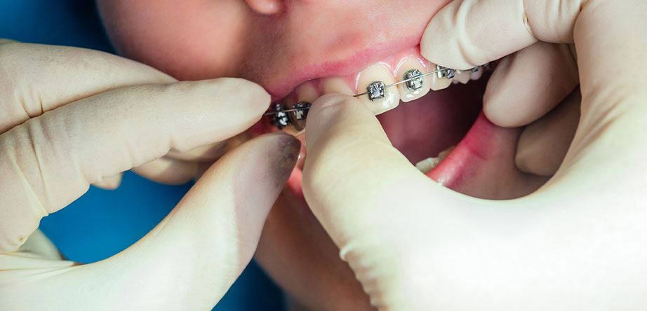 Do Braces Only Fix Aesthetics? The Health Benefits of Orthodontics