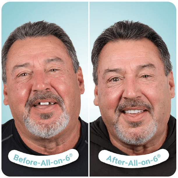all on 4 dental implants in tijuana mexico-1-03