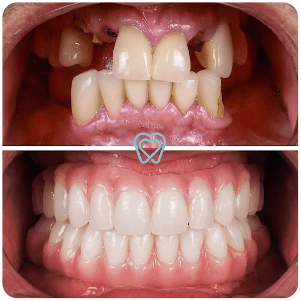 all on 4 dental implants in tijuana mexico-1-03