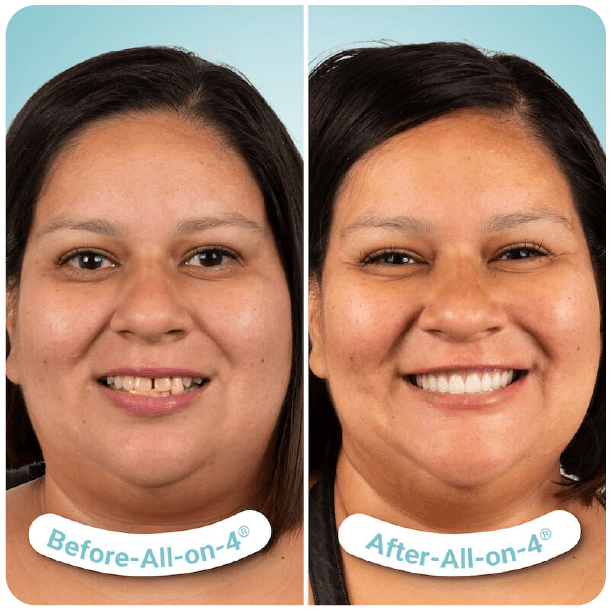 all on 4 dental implants in tijuana mexico-1-05