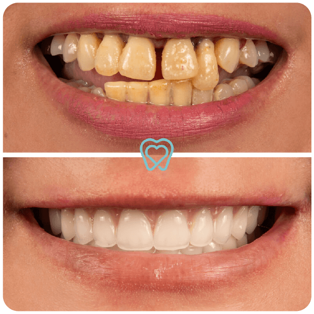 all on 4 dental implants in tijuana mexico-1-06