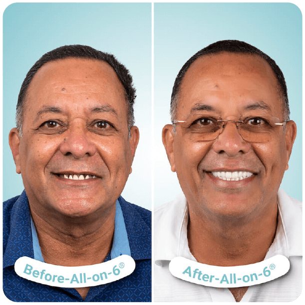 all on 4 dental implants in tijuana mexico-1-09