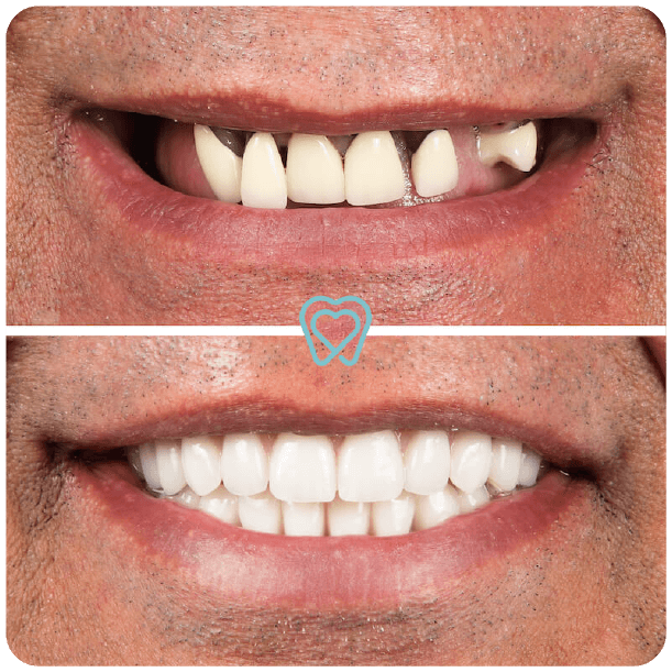 all on 4 dental implants in tijuana mexico-1-09