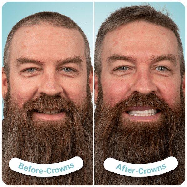 dental crowns in tijuana mexico-01