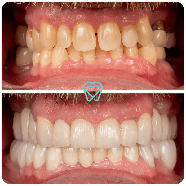dental crowns in tijuana mexico-02