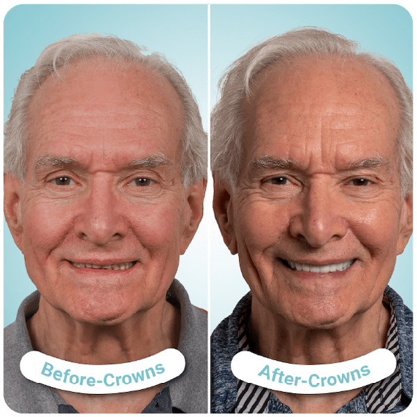 dental crowns in tijuana mexico