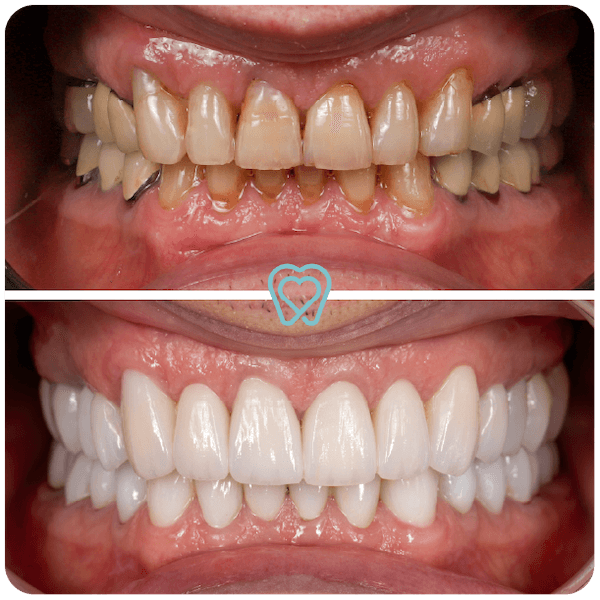 dental crowns in tijuana mexico