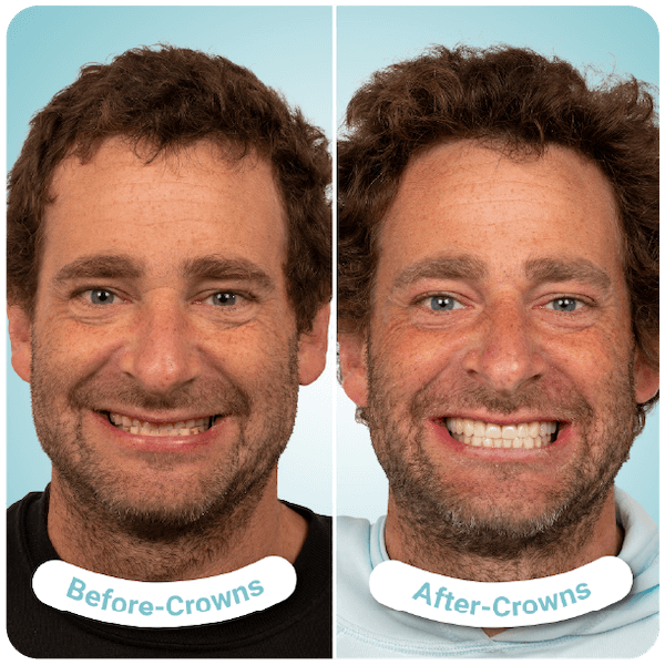 dental crowns in tijuana mexico