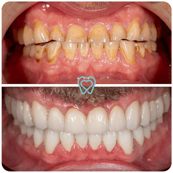dental crowns in tijuana mexico