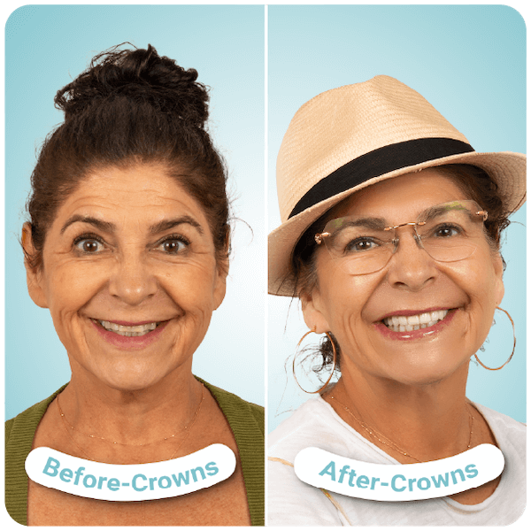 dental crowns in tijuana mexico