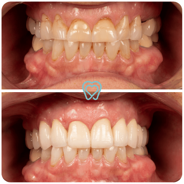 dental crowns in tijuana mexico