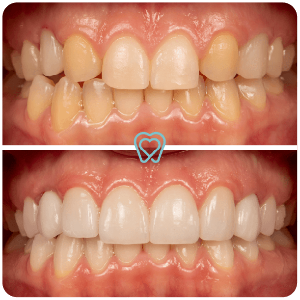 Veneers in Tijuana Mexico - I love my dentist Veneers in tijuana Mexico - I love my dentist