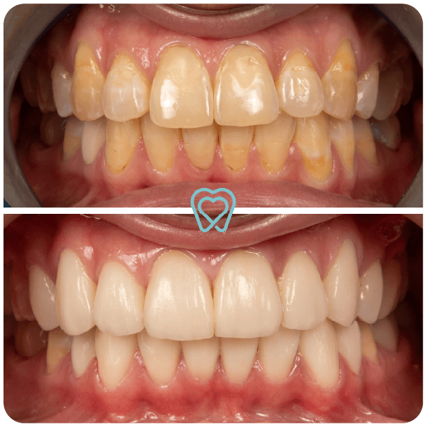 I love my dentist - Tijuana Mexico - Dental Veneers I love my dentist - Tijuana Mexico - Dental Veneers