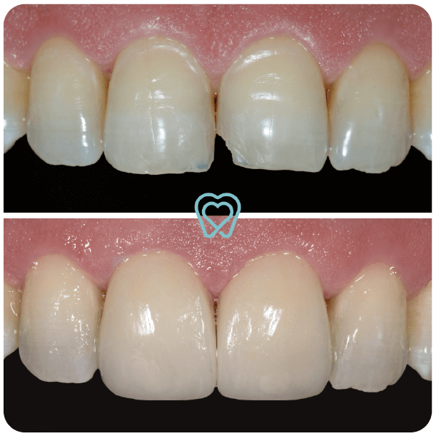 I love my dentist in Tijuana - Dental Veneers I love my dentist in Tijuana - Dental Veneers