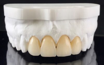 Caring for Your Dental Crowns: Tips for Long-Lasting Results