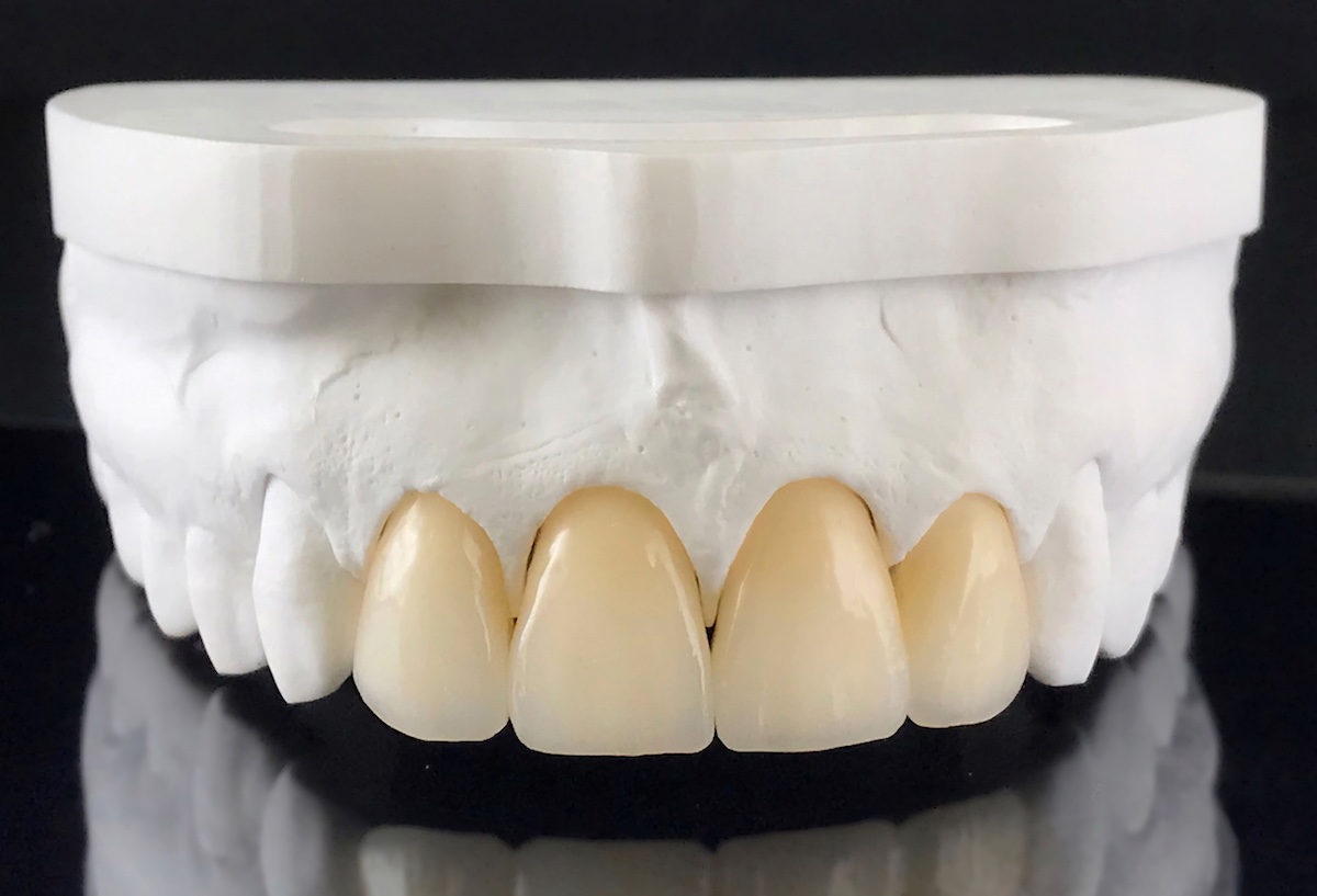 Caring for Your Dental Crowns: Tips for Long-Lasting Results