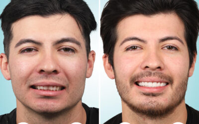 Transform Your Smile with Veneers in Tijuana: What You Need to Know