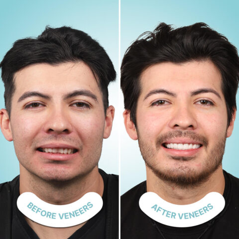 Transform Your Smile with Veneers in Tijuana: What You Need to Know - I