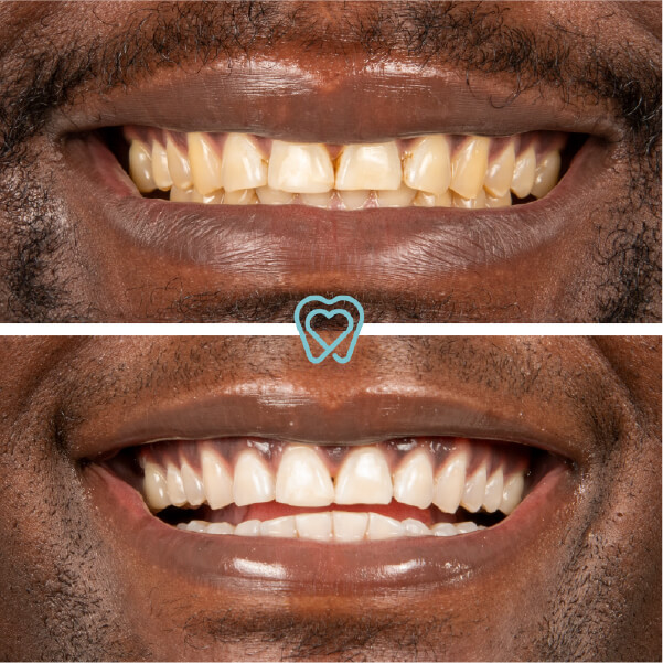 ZOOM! Teeth Whitening in Tijuana ZOOM! Teeth Whitening in Tijuana