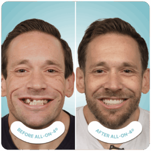all on 4 dental implants in tijuana mexico