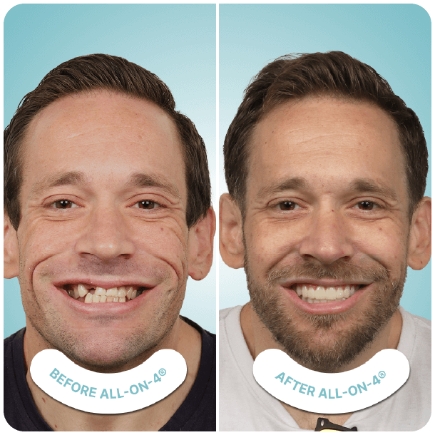 all on 4 dental implants in tijuana mexico