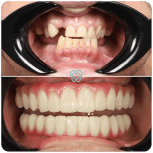 all on 4 dental implants in tijuana mexico