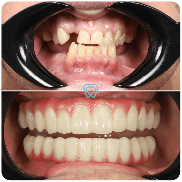 all on 4 dental implants in tijuana mexico