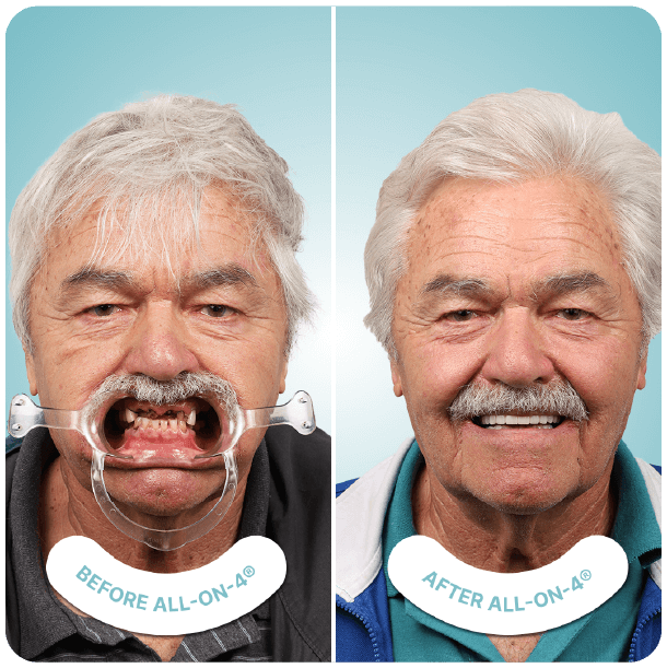 all on 4 dental implants in tijuana mexico